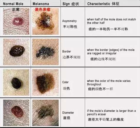 有毛的痣|黑痣、红痣、长毛的痣，哪种痣容易出现癌变？